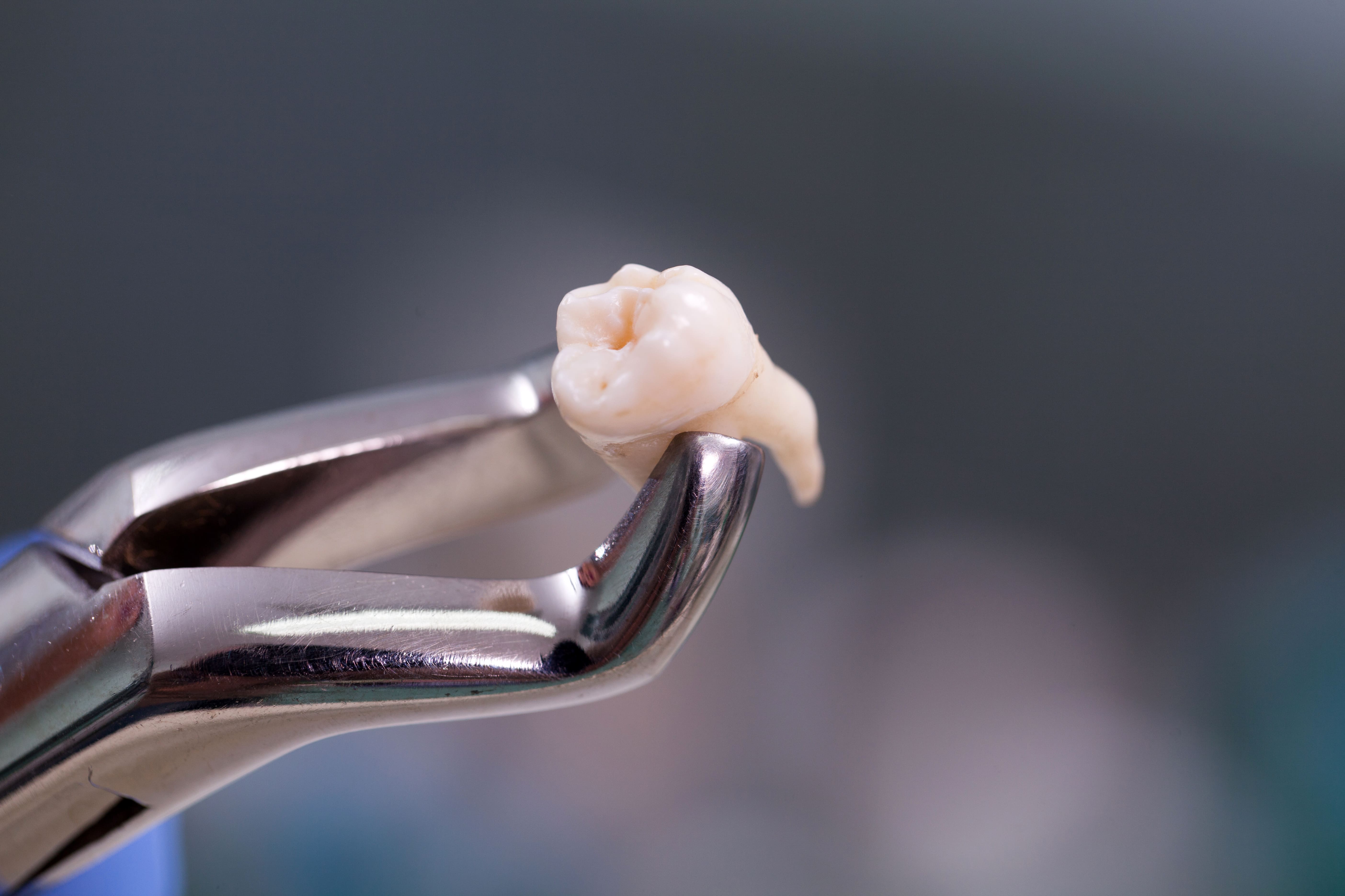 【抜歯と非抜歯、何が違うの？】矯正歯科治療を始める際の重要なポイントとは？