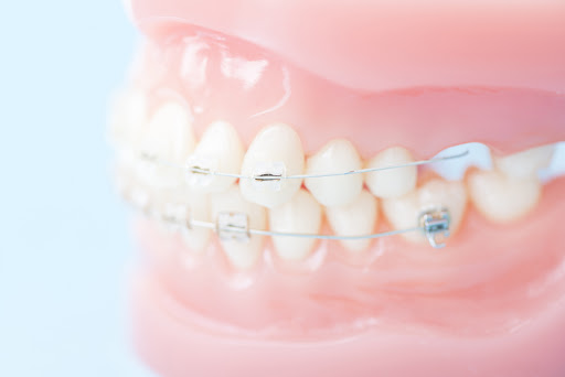 どんな歯並びだと矯正するべき？成人矯正と小児矯正の違いは？