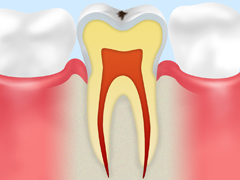 ごく初期の虫歯