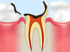 歯根まで達した虫歯