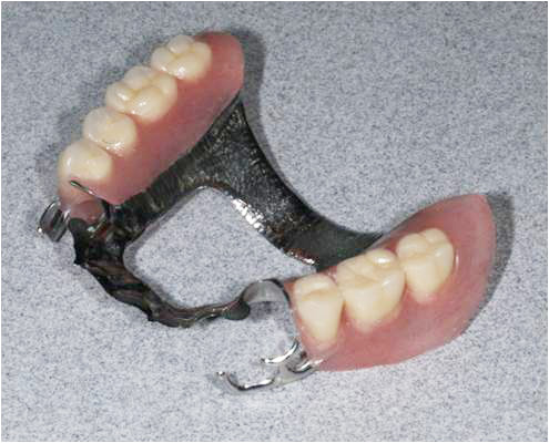 金属床義歯がおすすめです