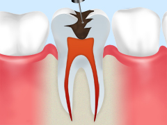 歯内療法の流れ