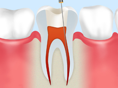 歯内療法の流れ