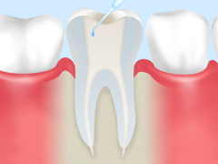 歯内療法の流れ