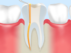 歯内療法の流れ