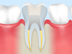 歯内療法の流れ