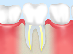 歯内療法の流れ