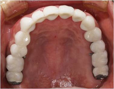 ⑫セラミックの素焼きの段階で歯の形態や細かい咬合接触などのチェックをします。