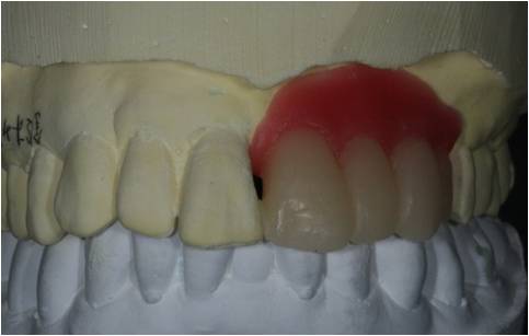 ②ワックスで作製した歯と歯肉。患者様に最終ゴールのイメージを見ていただきます。