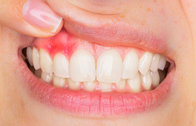 歯の生活習慣病の一つ「歯周病」